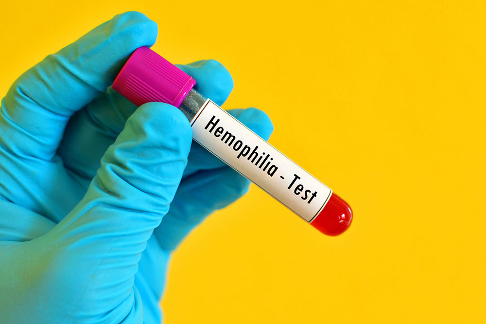 Hemophilia &#8211; Symptoms, Treatment, and Prevention