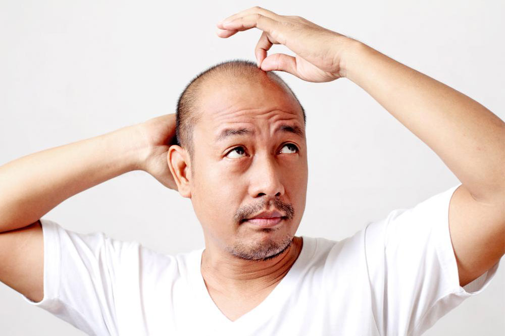 Male Pattern Baldness &#8211; Symptoms and Treatments