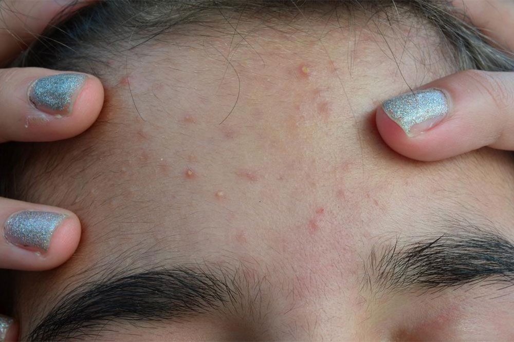 Risk Factors and Tips to Manage Acne