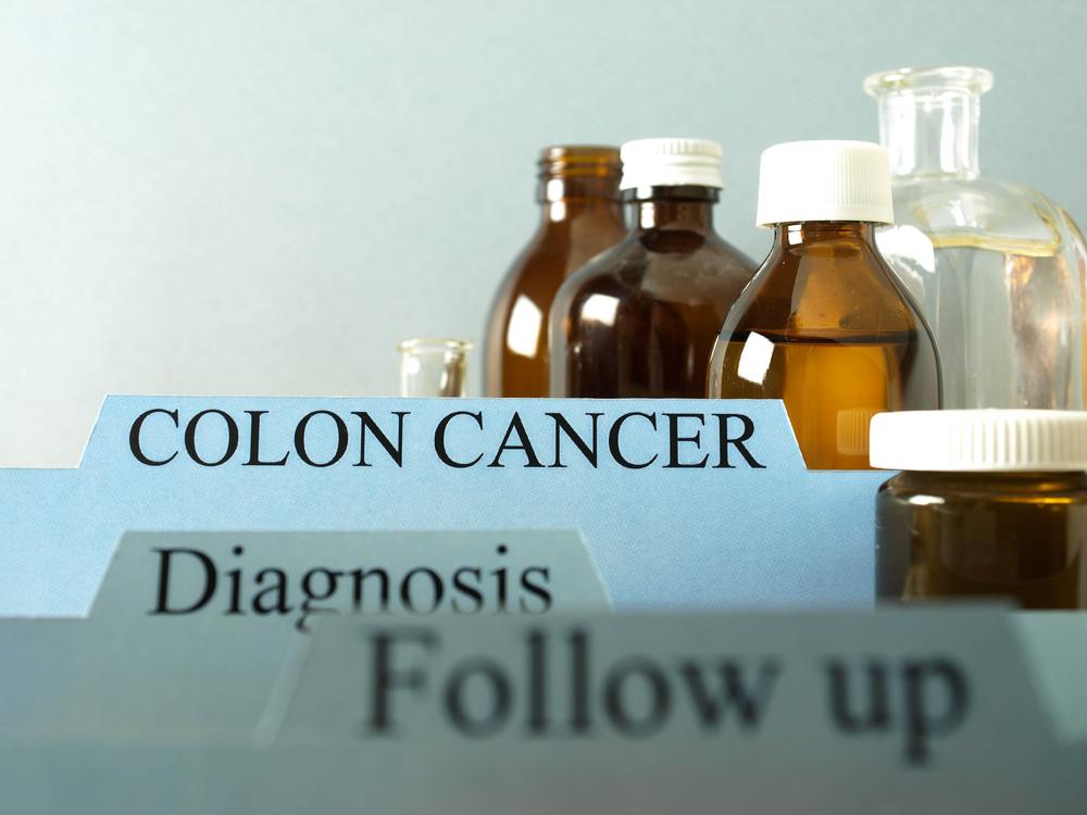 The Main Stages of Colon Cancer